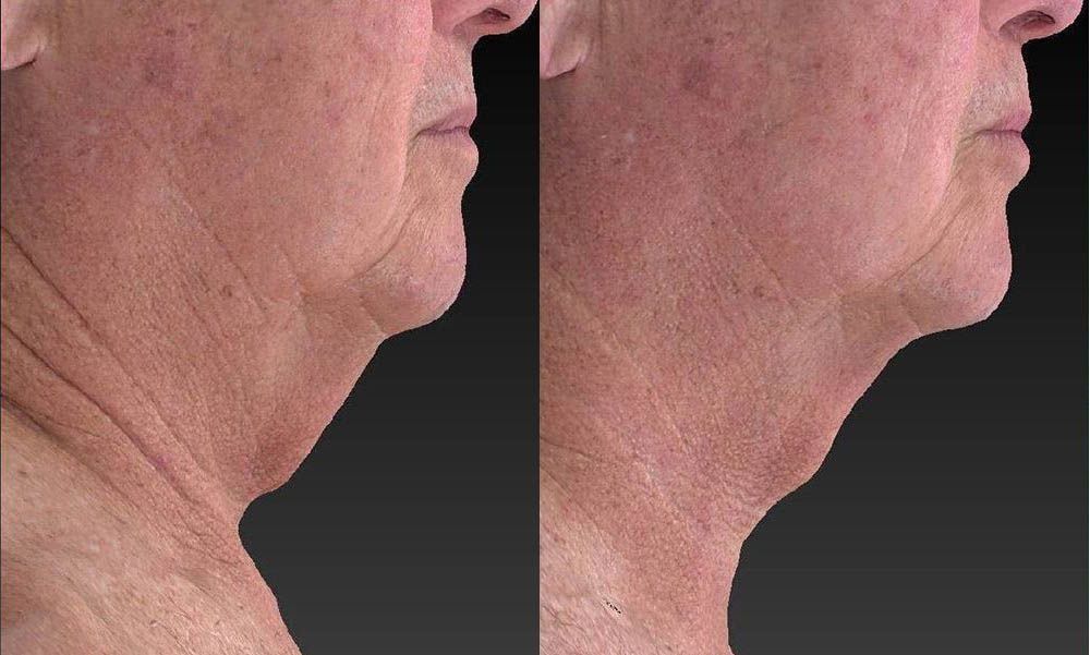 Side-by-side profile views of a person’s neck and lower face, showing skin texture against a dark background.