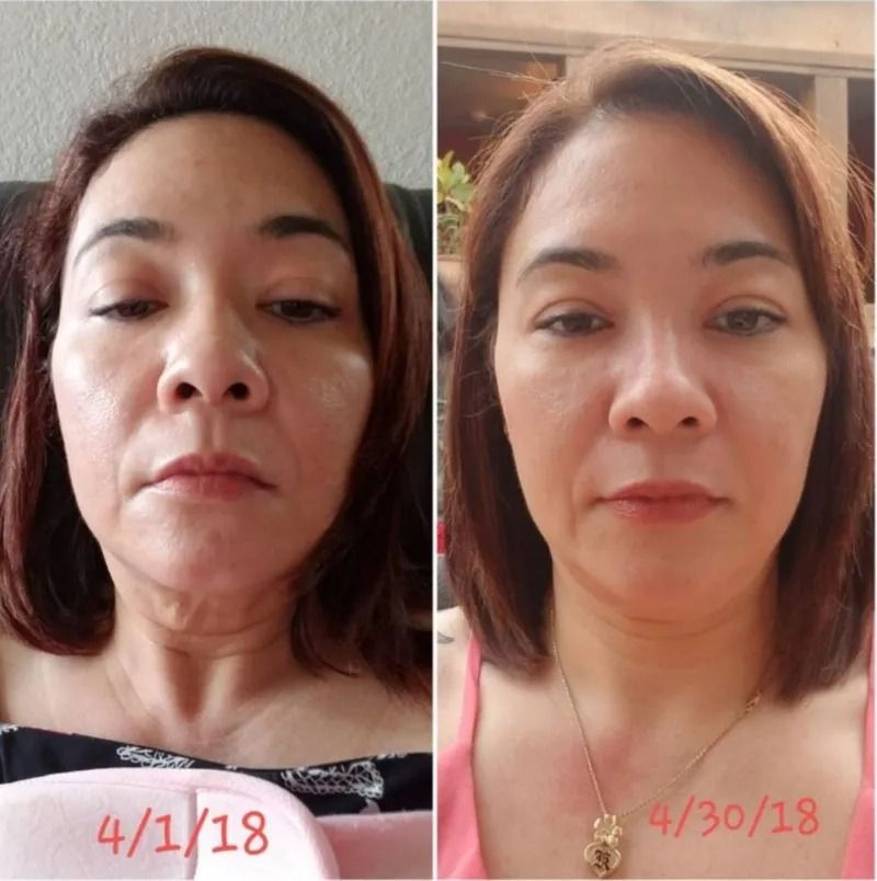 Side-by-side portrait selfies of the same person, dated 4/1/18 and 4/30/18, showing a facial comparison.