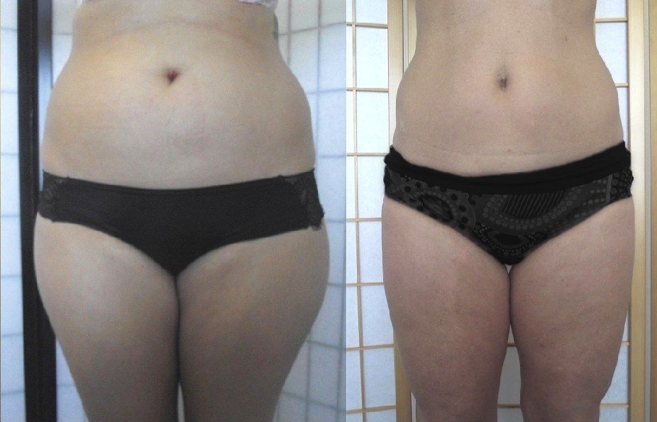Side-by-side photo of a torso in black underwear, showing front view comparison.