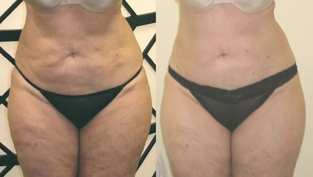 Side-by-side torso photos showing a person in black underwear, comparing body shape before and after.