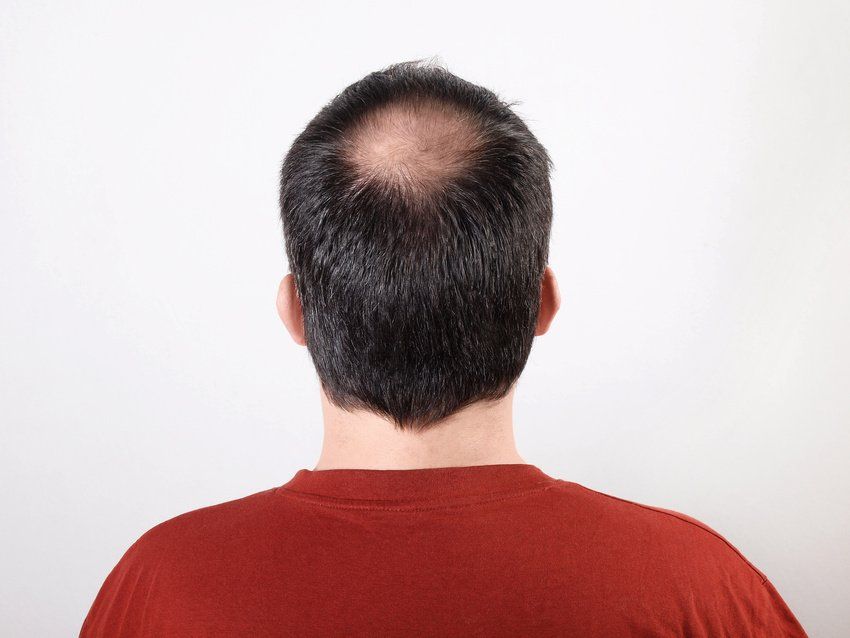 The back of a man 's head with a bald spot.