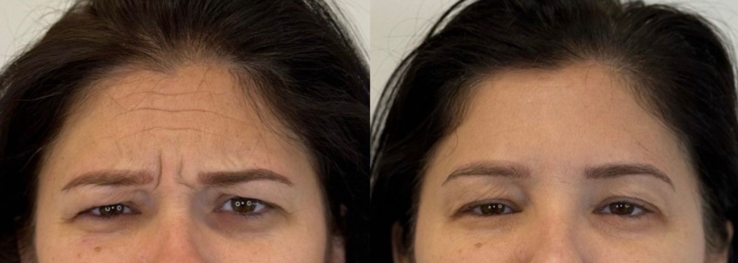 Before-and-after comparison of a forehead and eye area, showing a reduction in expression lines after cosmetic treatment.