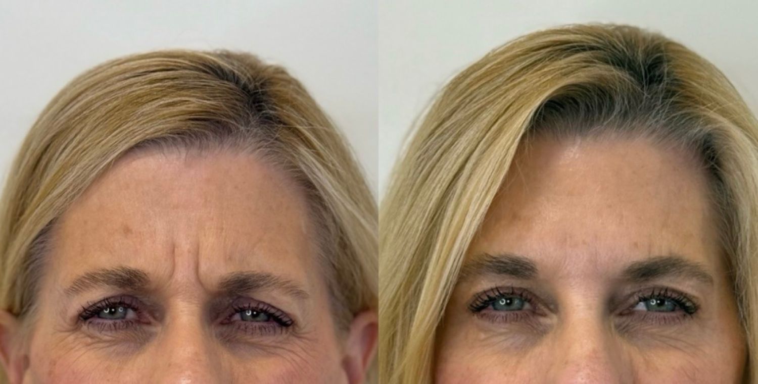 Before and after comparison of a woman's forehead showing a reduction in wrinkles after cosmetic treatment.
