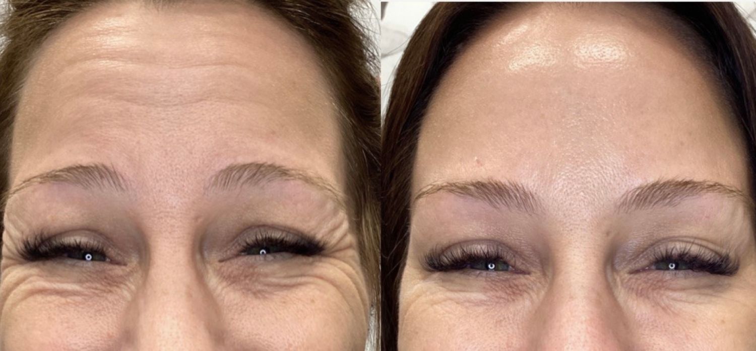A side-by-side comparison of a forehead before and after cosmetic treatment, showing a reduction in expression lines.