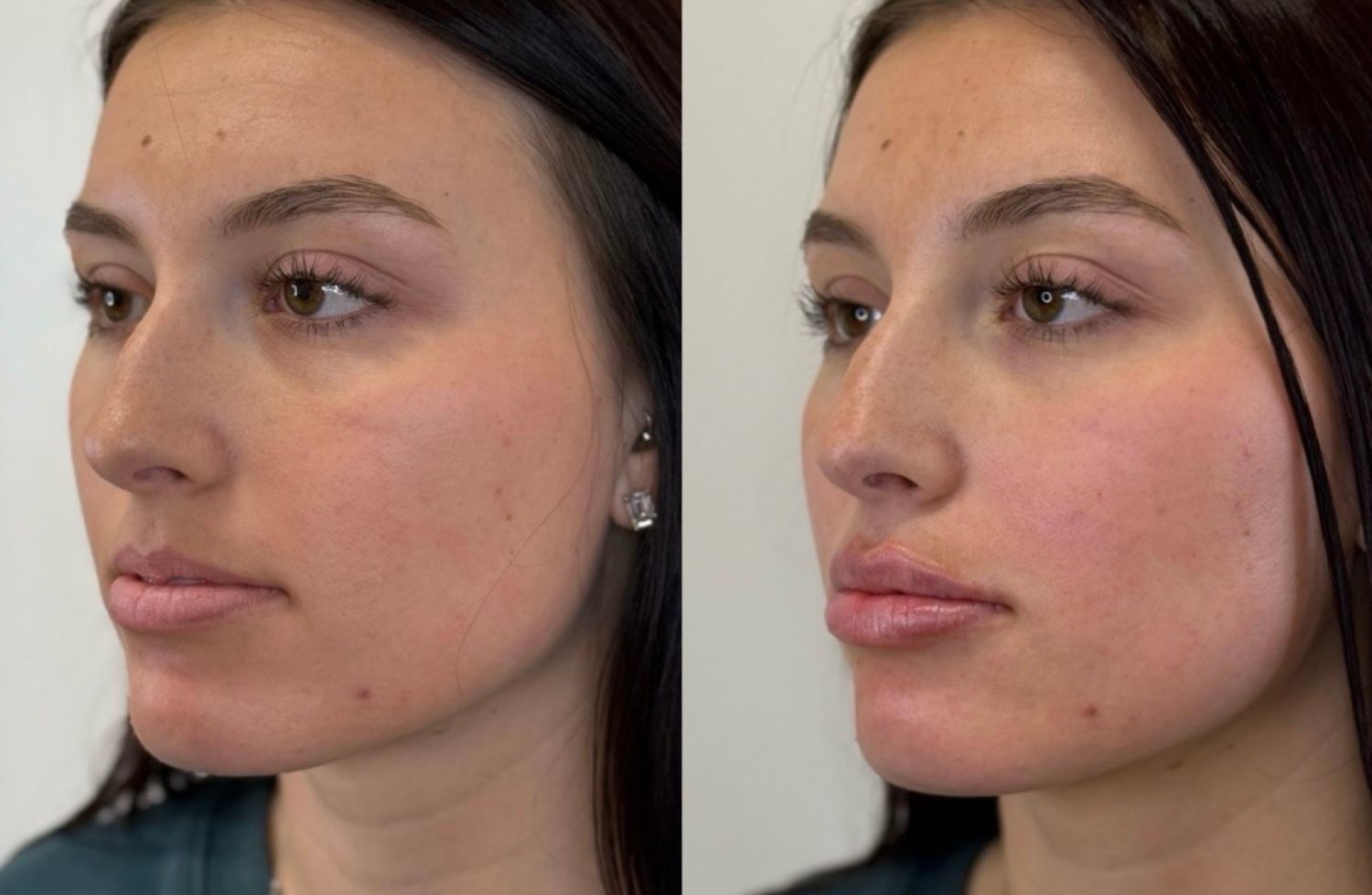 Before and after comparison of a person's face showing subtle changes in lip fullness and contouring.