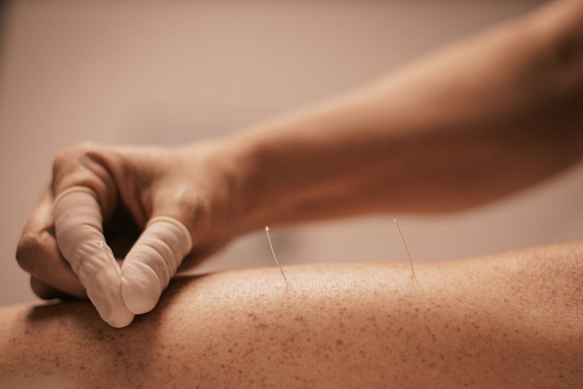 Dry Needling Treatment