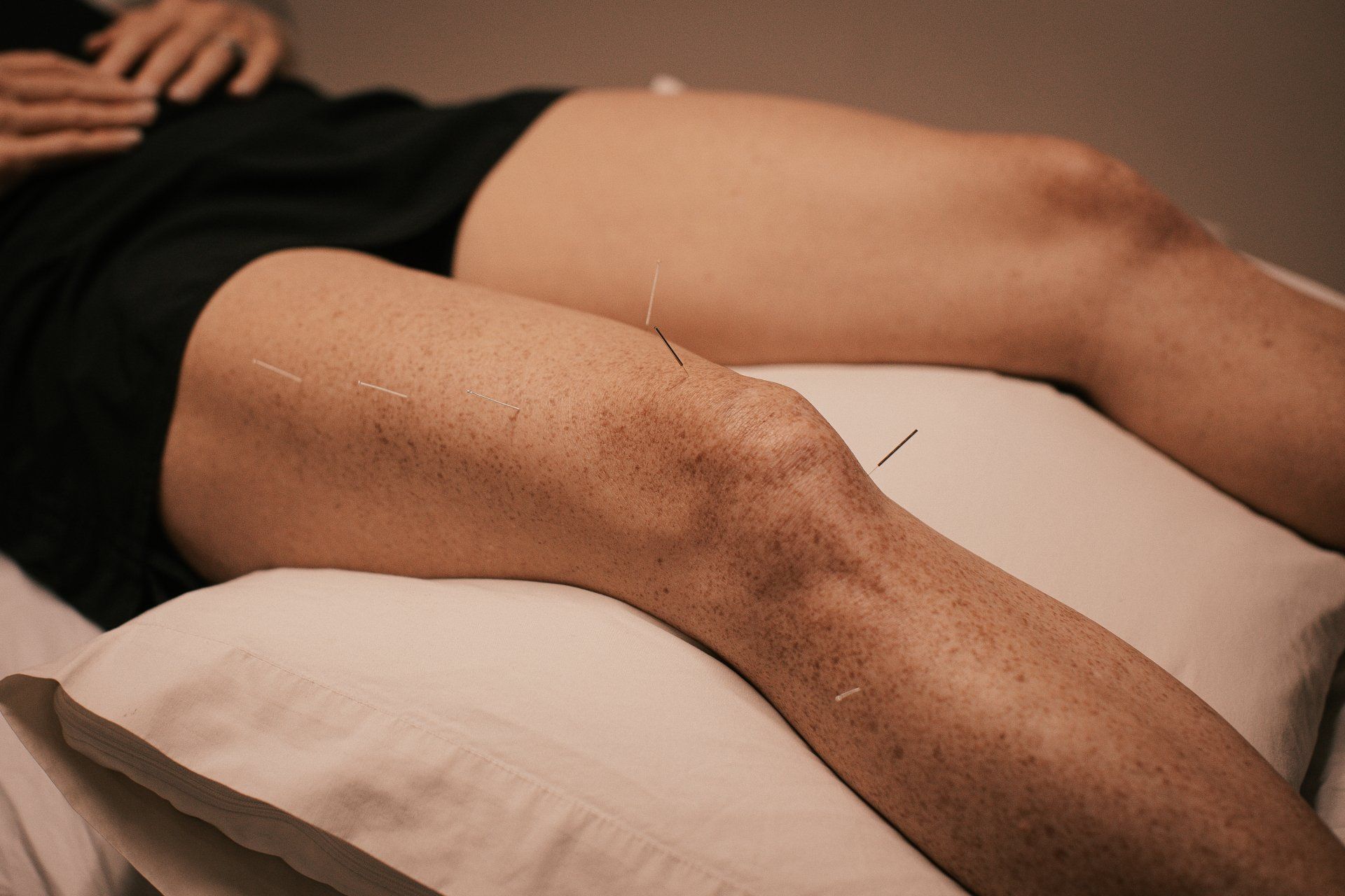 Dry Needling Treatment