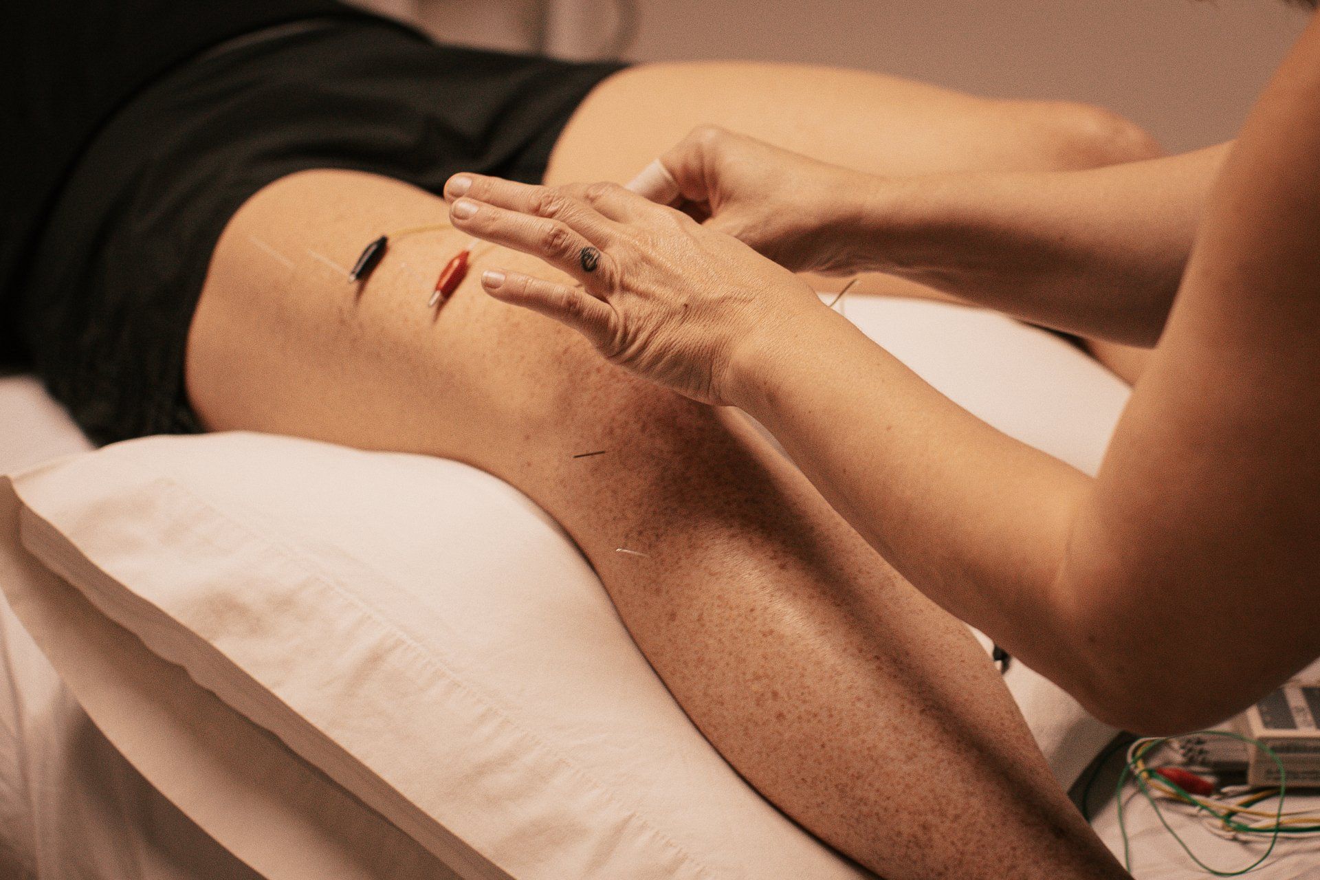 Dry Needling Treatment