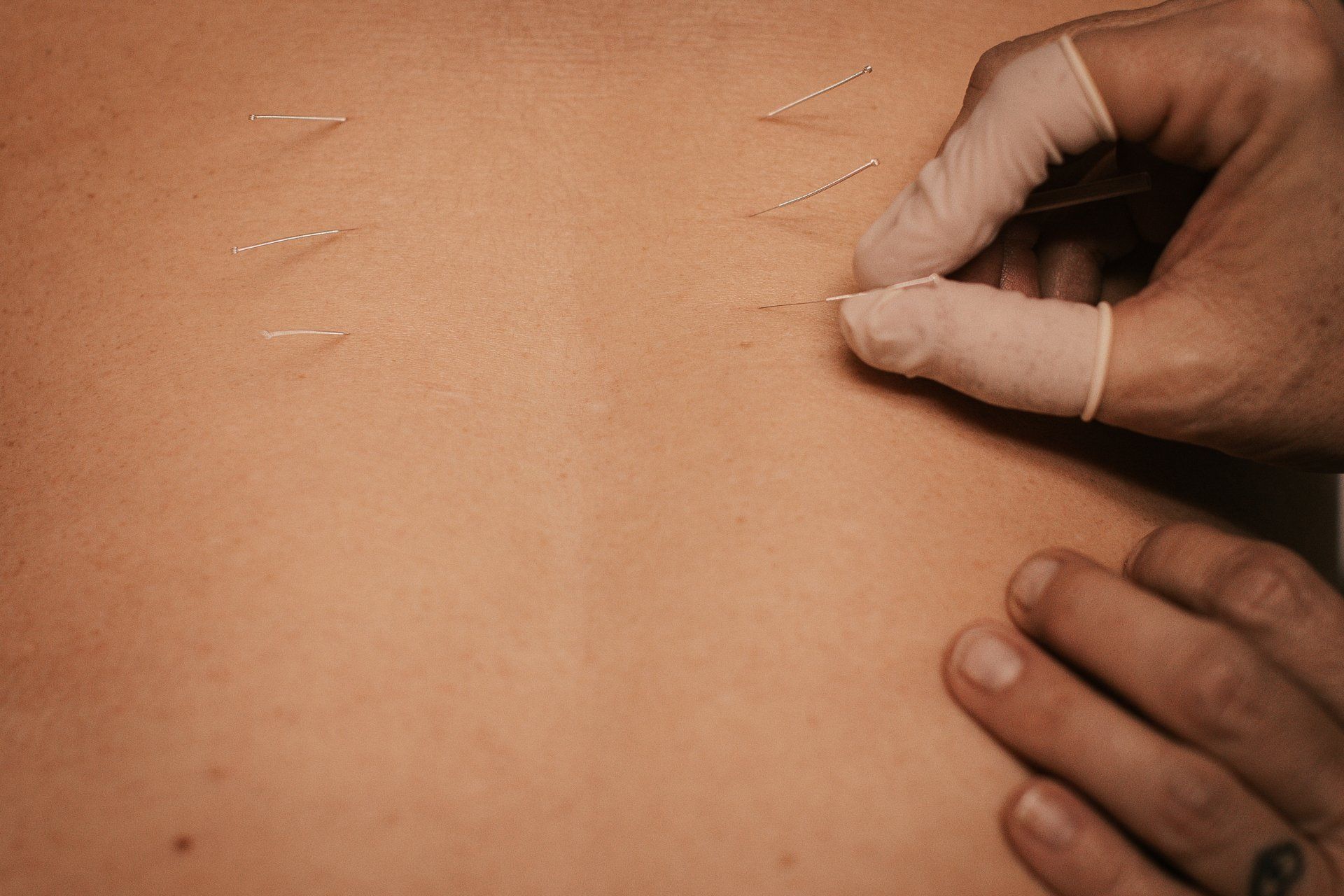 Dry Needling Treatment