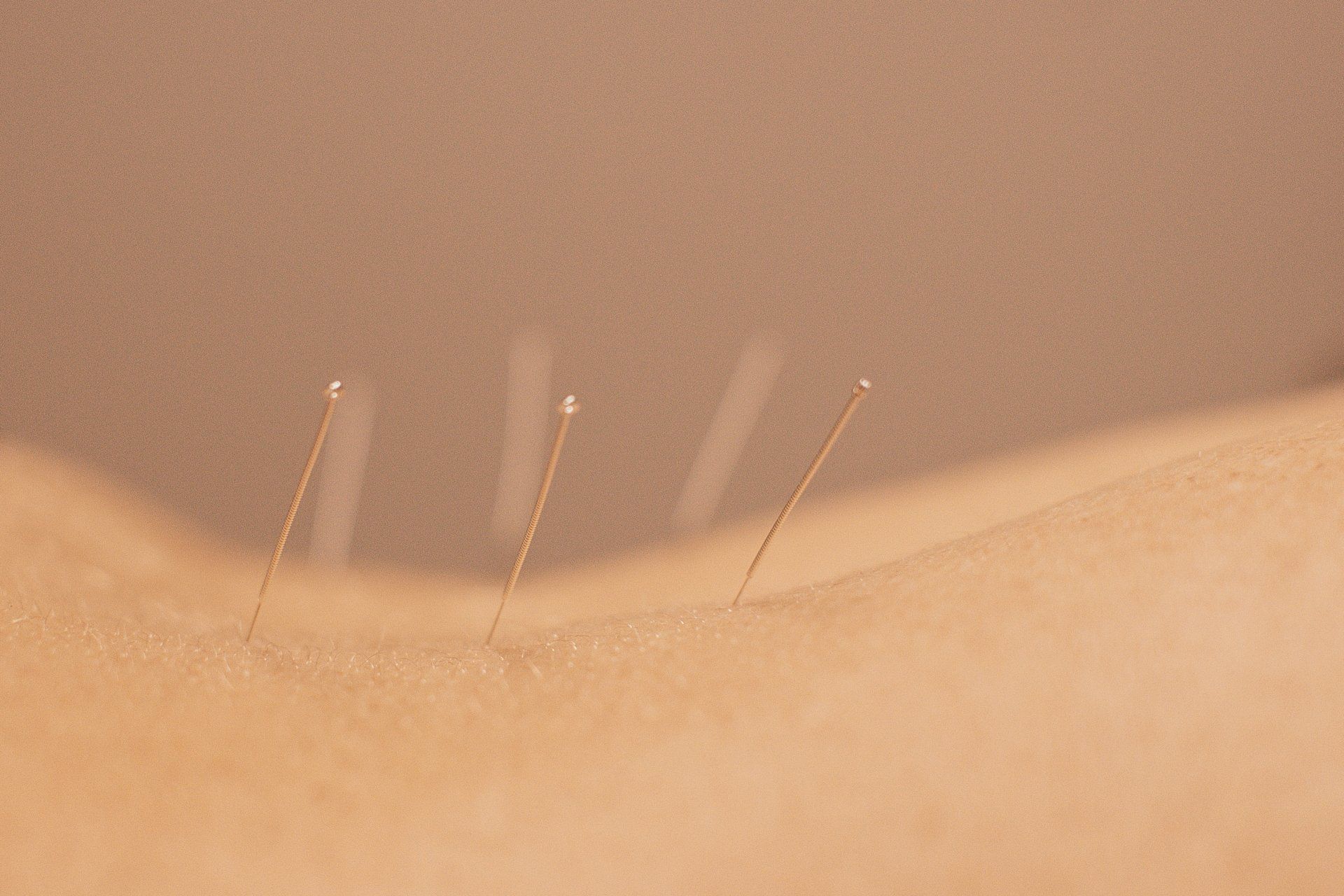 Dry Needling Treatment