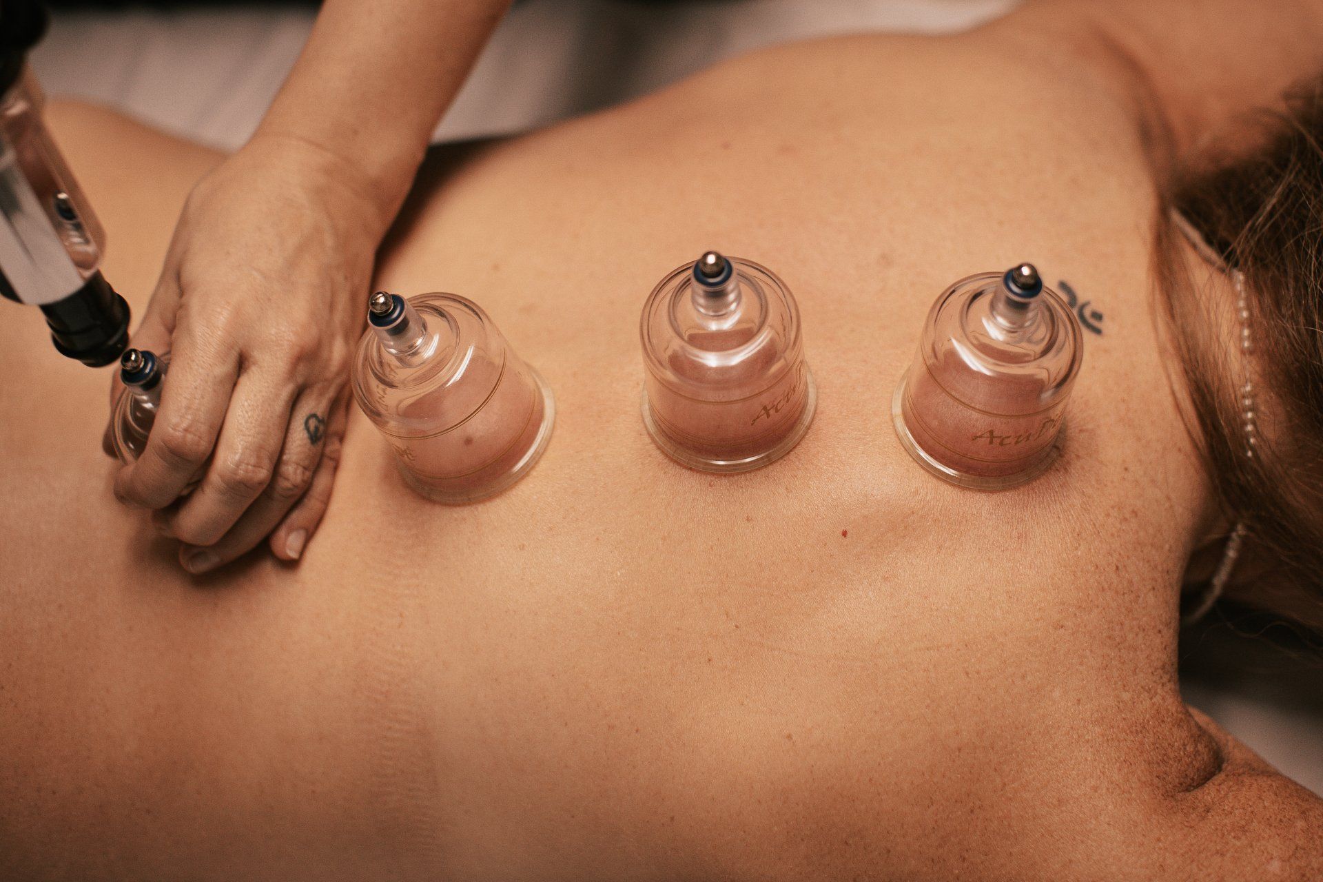 MediCupping Treatment