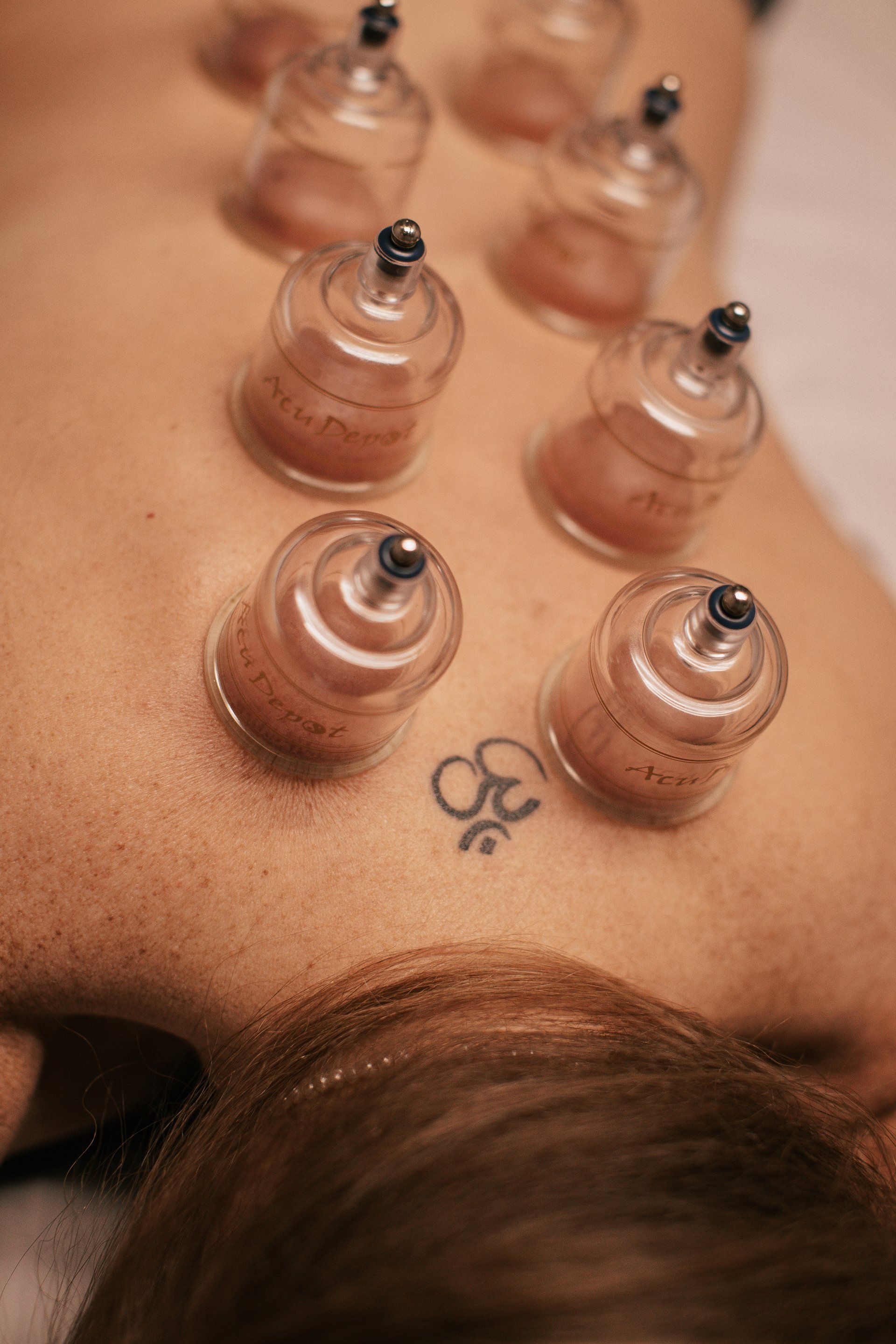 MediCupping Treatment