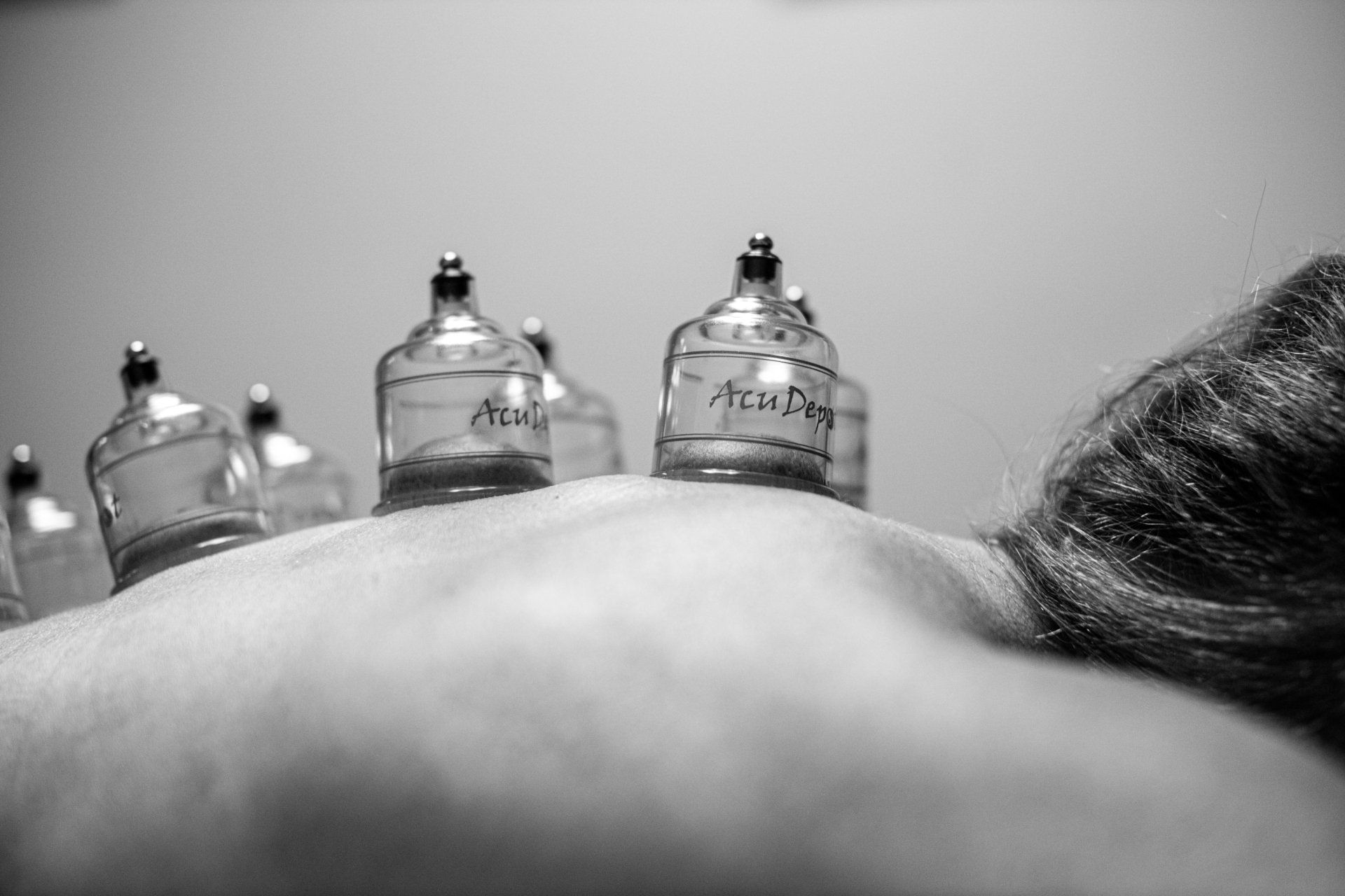 MediCupping Treatment