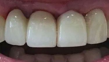 dental work after