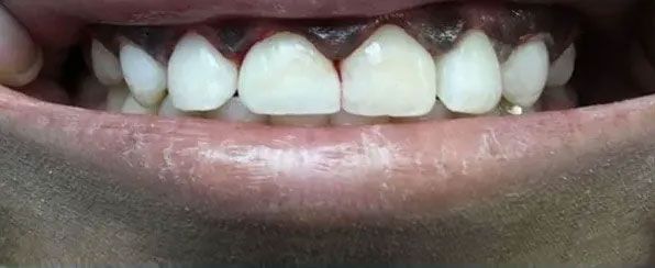dental work after