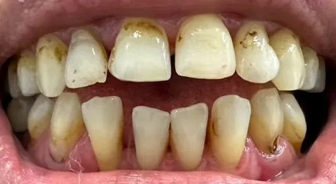 dental work before