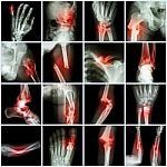 Joint Replacement x rays in Victorville & Hesperia, CA