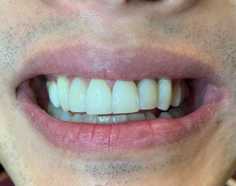 A close up of a man 's teeth with a beard.