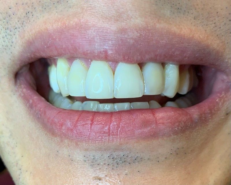 A close up of a man 's mouth with white teeth.