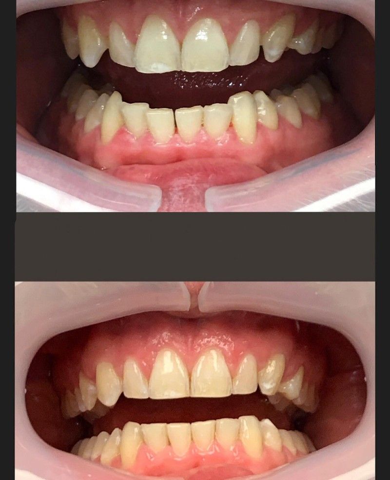 A before and after picture of a person's teeth