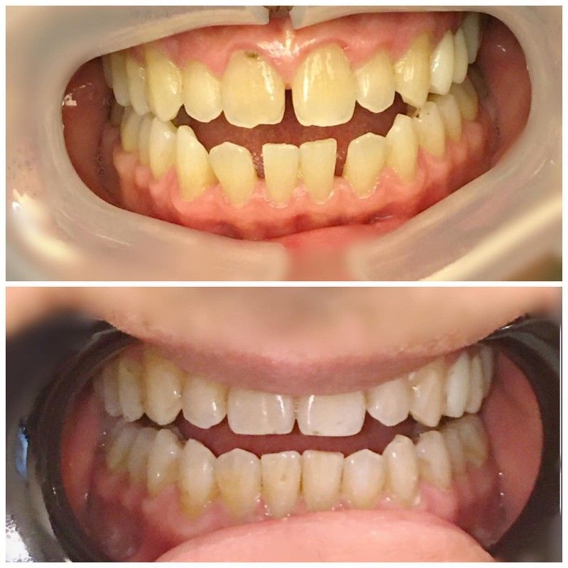 A before and after picture of a person's teeth