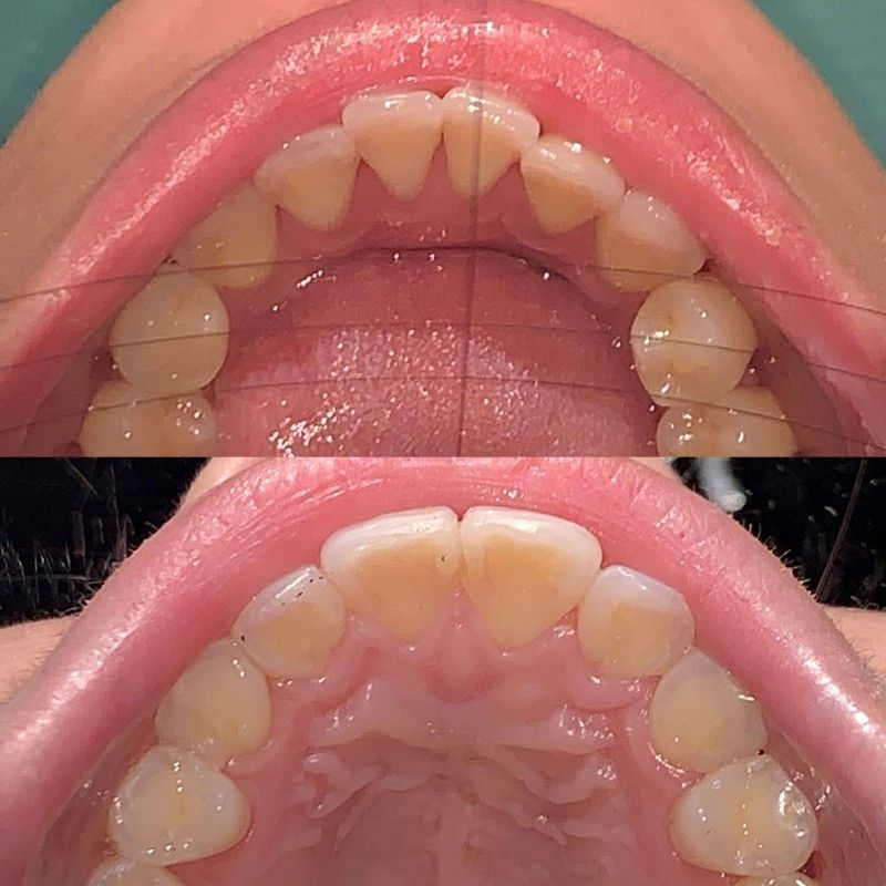 A before and after picture of a person's teeth