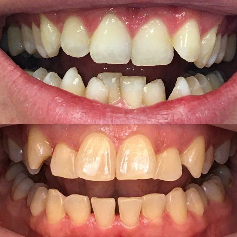 A before and after picture of a person's teeth
