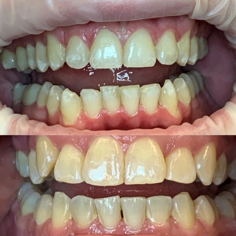 A before and after picture of a person's teeth.