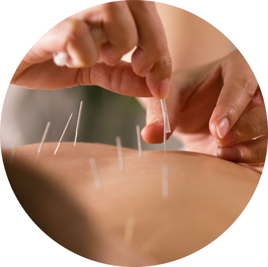 Back acupuncture
