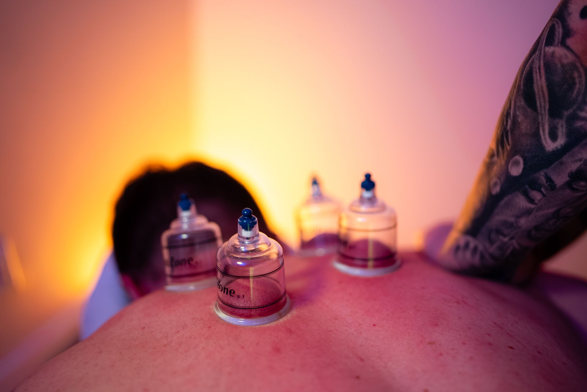 Cupping therapy session on a person's back