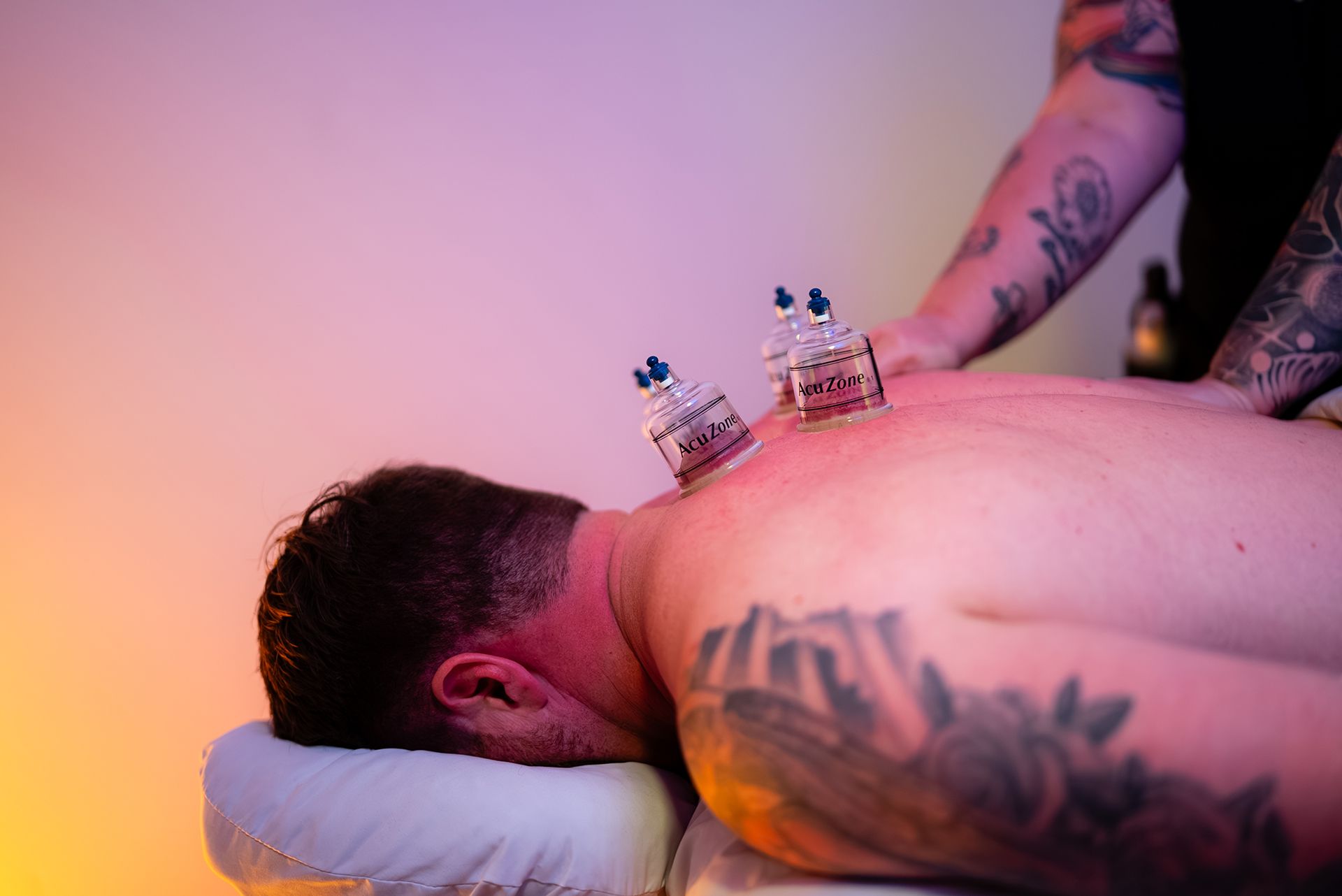 Person receiving cupping therapy on their back