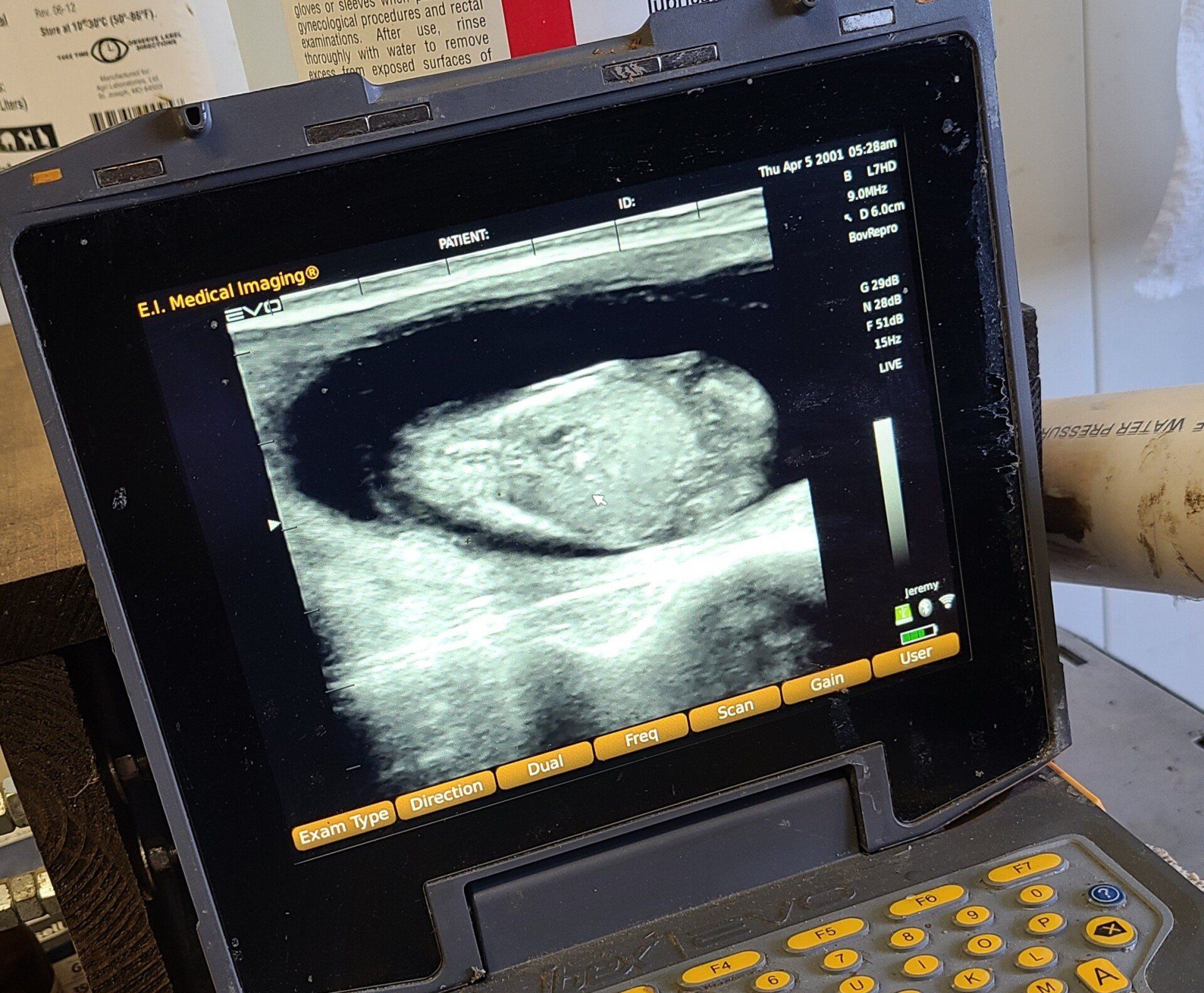 Pregnancy Ultrasound