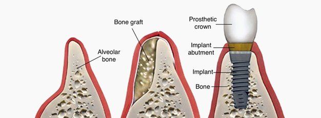 Dental bone grafting