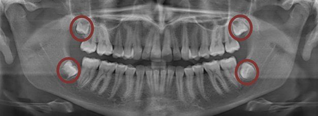 Teeth x-ray