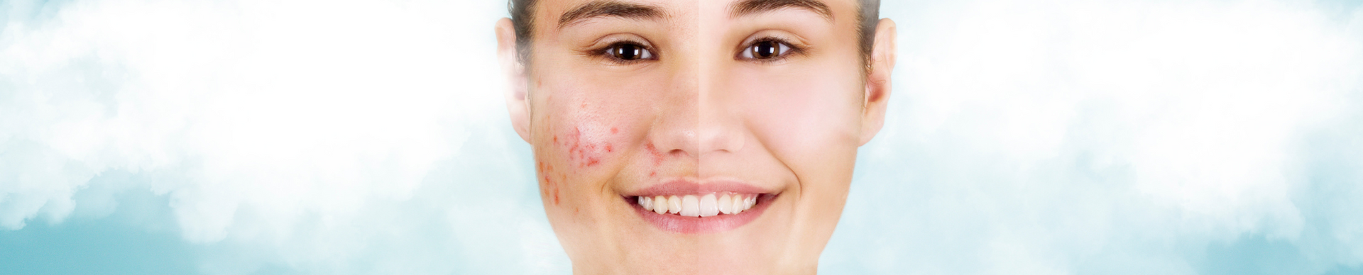 Woman's face shows before-and-after skin treatment. One side has acne, other side clear. Smiling.