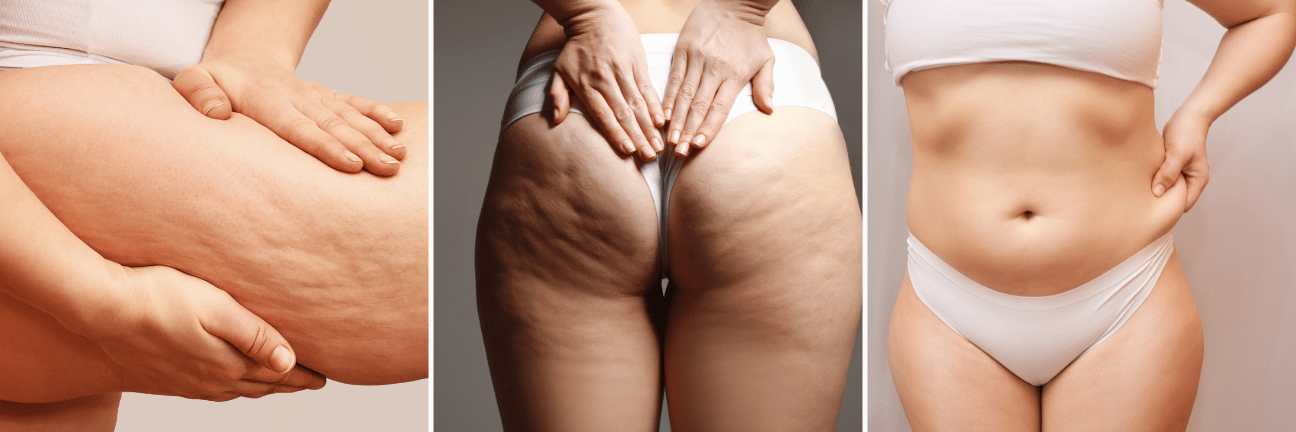 Three views of body parts showing cellulite: thigh, butt, and stomach. Hands pinch and hold skin.