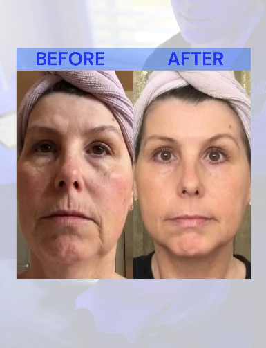 Side-by-side comparison shows a woman's face before and after a cosmetic treatment, reducing wrinkles.