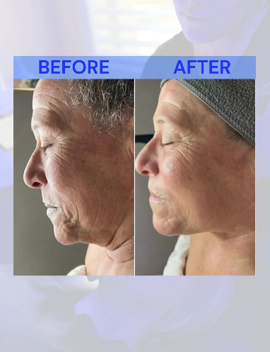 Side-by-side comparison. Woman's face before and after treatment, showing reduced wrinkles and tighter skin.