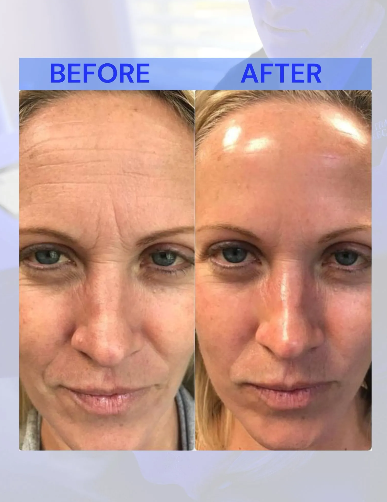 Before-and-after facial comparison: Wrinkled forehead smoothed after cosmetic procedure.