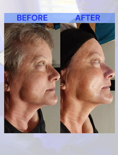 Side-by-side comparison of a person's profile: before (left) with wrinkles, and after (right) with smoother skin.