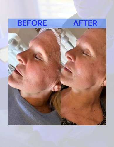 Comparison: woman's face before and after a skin treatment. Left side shows wrinkles; right side shows smoother skin.