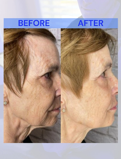 Side-by-side comparison of woman's profile: before (left) with thinning hair, after (right) with fuller hair and smoother skin.