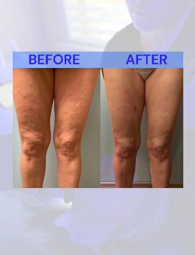Comparison of legs before and after cellulite treatment; reducing skin dimpling.