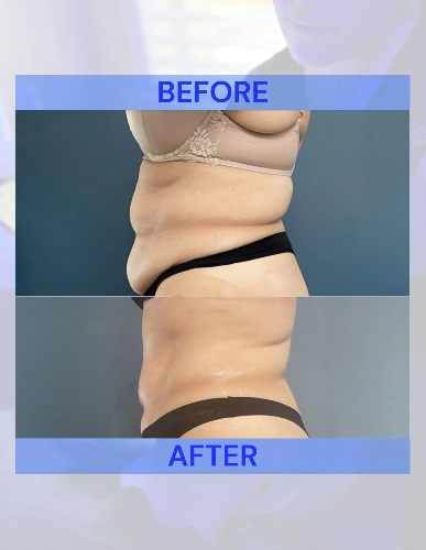 Side-by-side comparison of a torso: before and after body contouring. The 