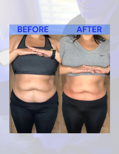 Side-by-side comparison of a person's torso before and after a procedure, showing reduced abdominal fat.