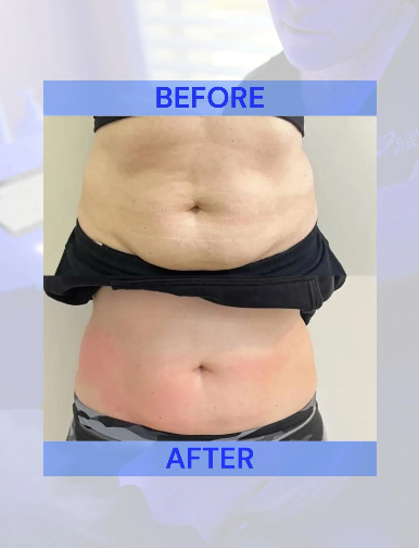 Side-by-side comparison of a person's abdomen, labeled 