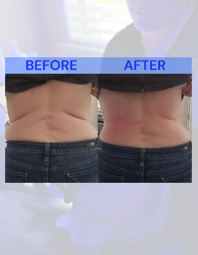 Comparison of a person's back before and after treatment, showing a reduction in fat and smoother appearance.