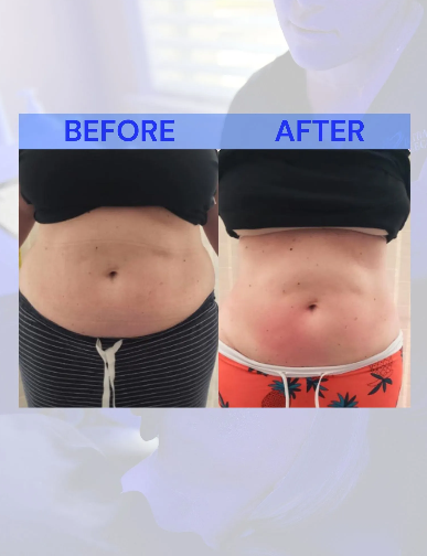 Side-by-side comparison of a torso before and after a treatment, with the 