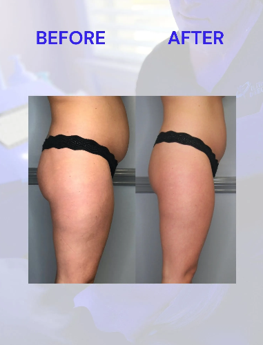 Side-by-side comparison: before and after shots of a person's torso and thighs, with noticeable reduction in abdominal and thigh fat.