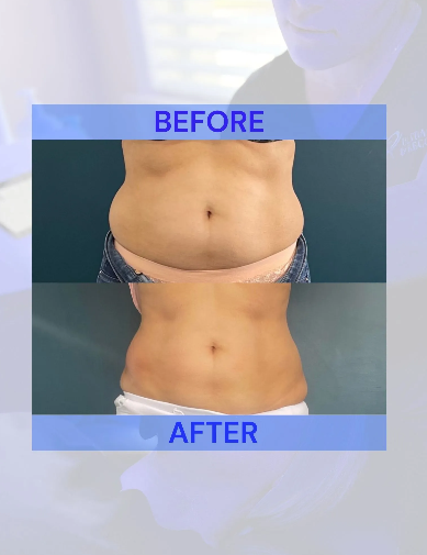 Side-by-side comparison of a person's abdomen, showing before and after treatment with reduced fat.